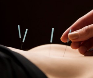 acupuncture